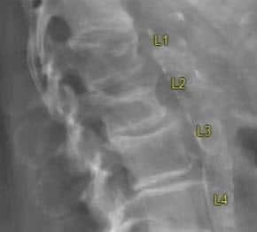L1和L2脊柱骨折